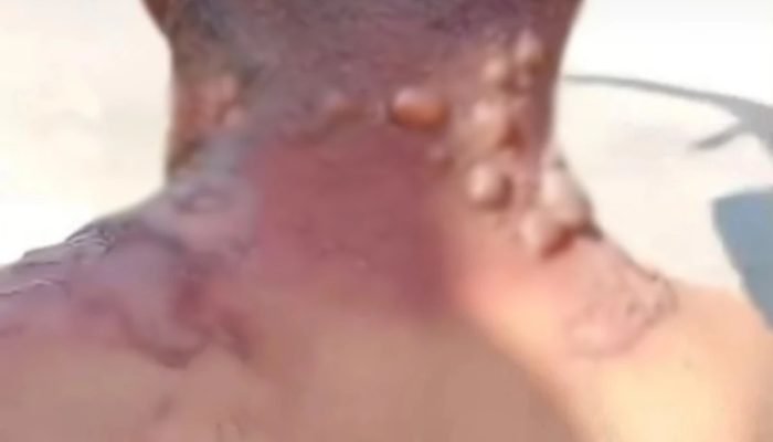 Homem é queimado por namorada com água quente